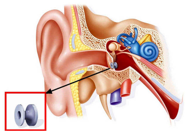 Kulak Tüpü (Ventilasyon Tüpü)